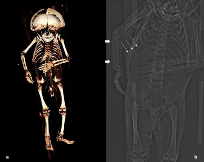 400 yıl önce ölen mumyalanmış: Gizemi çözüldü