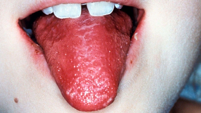 Bir haftada 6 çocuk ölümü! Strep A bakterisinin belirtileri neler?