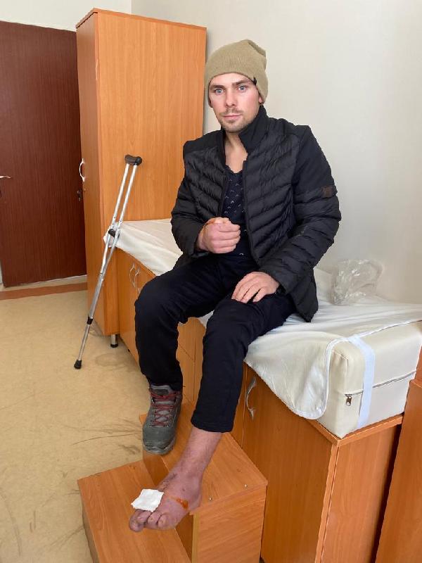 Kopan el parmağı, ayak parmağı ile yer değişti