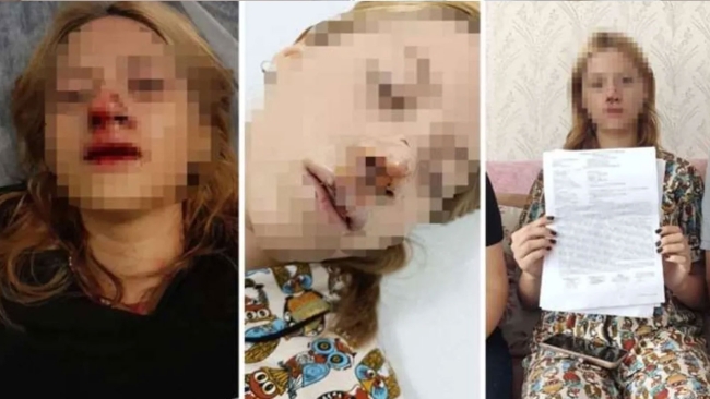 Genç kızın suratına taş atıp dişlerini kırmıştı! Tahliye edildi