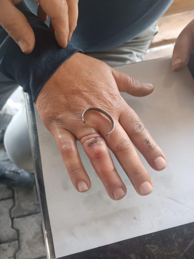 Parmağına sıkışan yüzüğü itfaiye çıkarttı