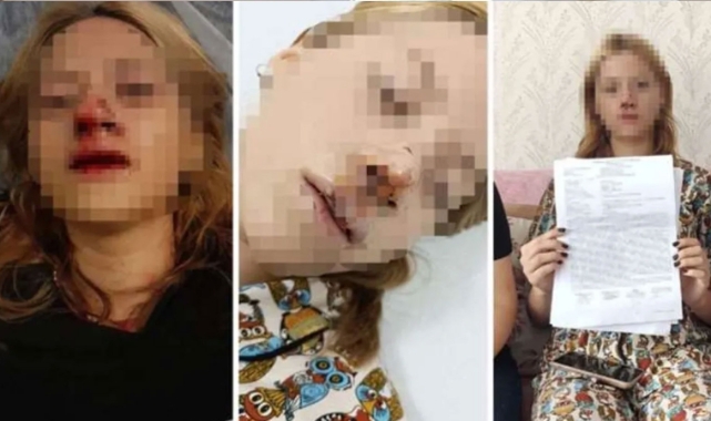Genç kızın suratına taş atıp dişlerini kırmıştı! Tahliye edildi
