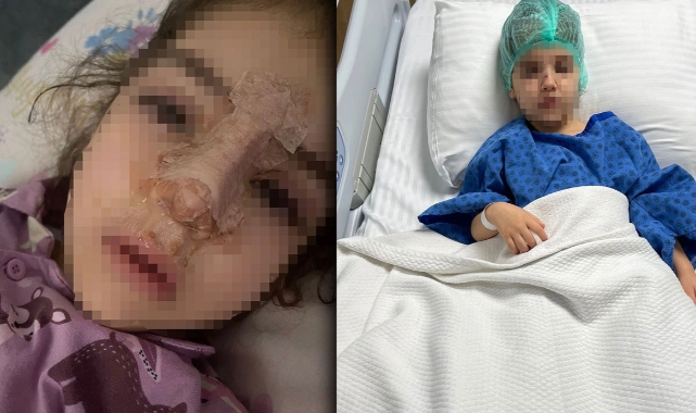 Kreşte 4 yaşındaki çocuklarının burnu kırılan aile, yetkililerden şikayetçi oldu