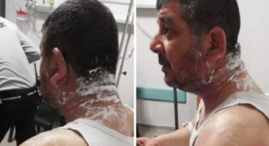 Hatay Meclisi üyesi adayına asitli saldırı