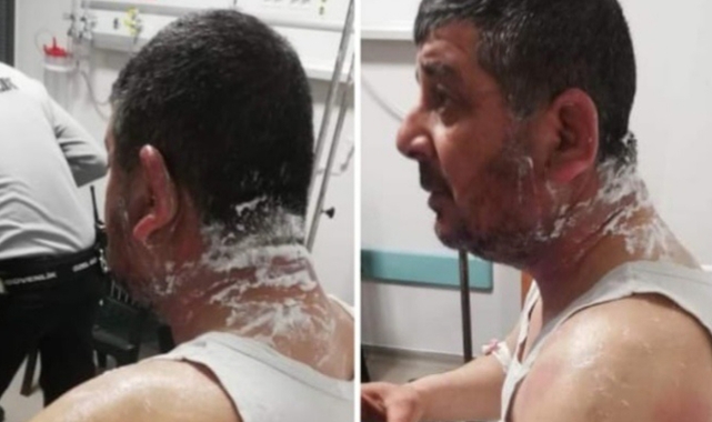 Hatay Meclisi üyesi adayına asitli saldırı
