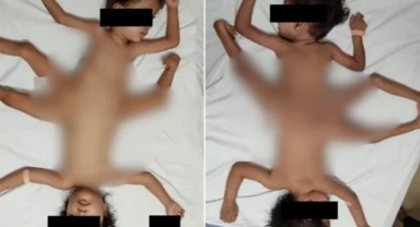 2 milyonda bir görülen "Örümcek ikizler" hastalığı