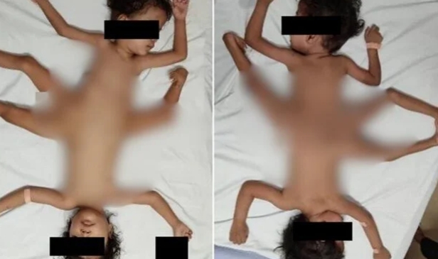 2 milyonda bir görülen "Örümcek ikizler" hastalığı