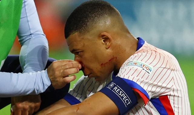 Mbappe’nin burnu kırıldı