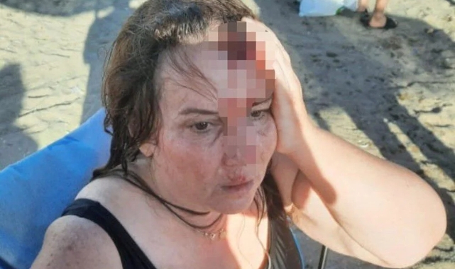 Denizde yüzerken Jet ski çarptı, ölümden döndü