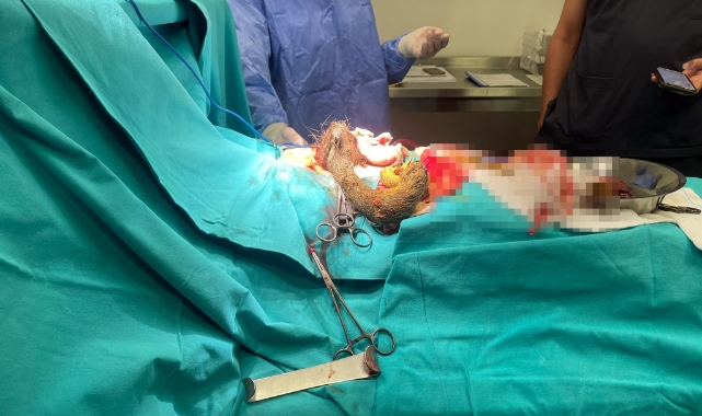14 yaşındaki kız çocuğunun midesinden 3.5 kilo saç kılı çıktı