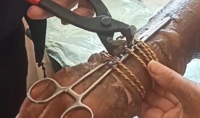 Kolu yanan kadının bilezikleri kesilerek çıkartıldı