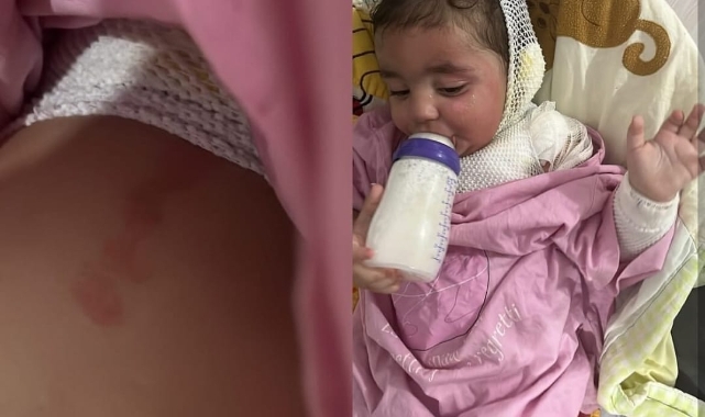Kreşte çocuğun üzerine kahve döküldü   