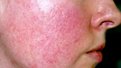 Hayat Hastanesi Dermatoloji Uzmanı Dr. Meliha Yılmaz: "Gül hastalığı ihmal edilmemeli"