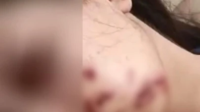 Yüzüne maytap isabet eden genç kız yaralandı